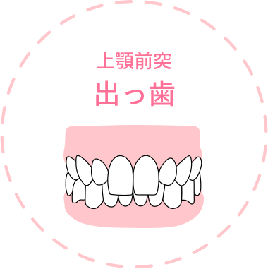 上顎前突 出っ歯