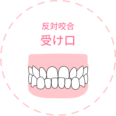 反対咬合 受け口