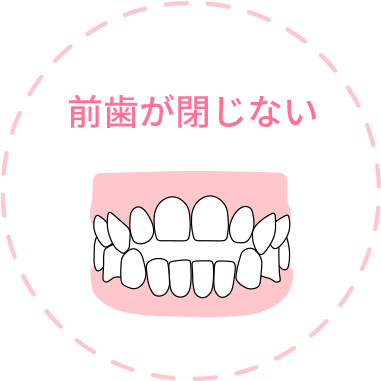 前歯が閉じない